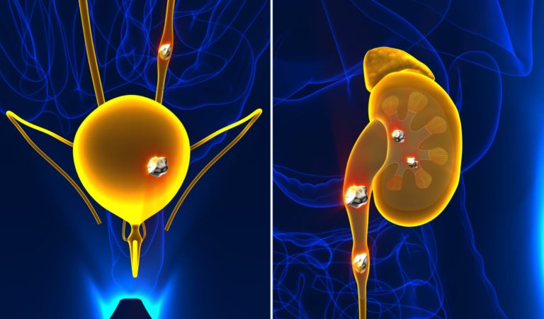 Main Image Kidney Stone