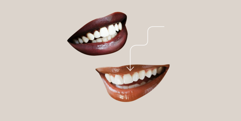 veneers-1599662662