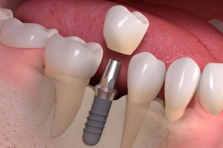 Understanding the Costs of Dental Implants in Edinburgh